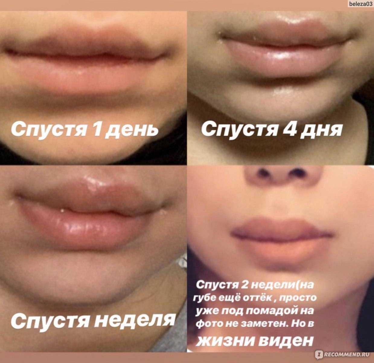 Что нельзя делать после увеличения губ гиалуроновой кислотой