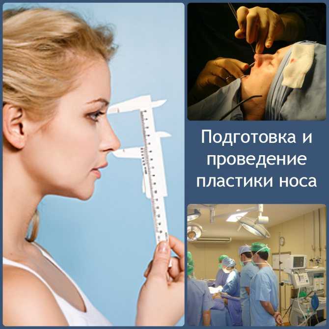 Пластика носа: кому показана, виды, фото, стоимость операции - idealplastic.ru