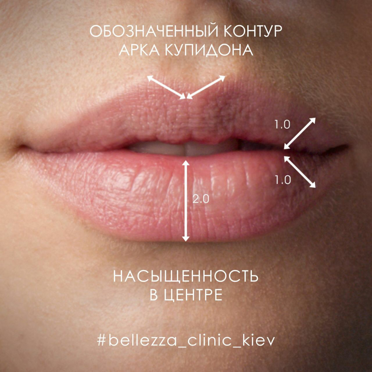 Почему увеличенные губы это ужасно