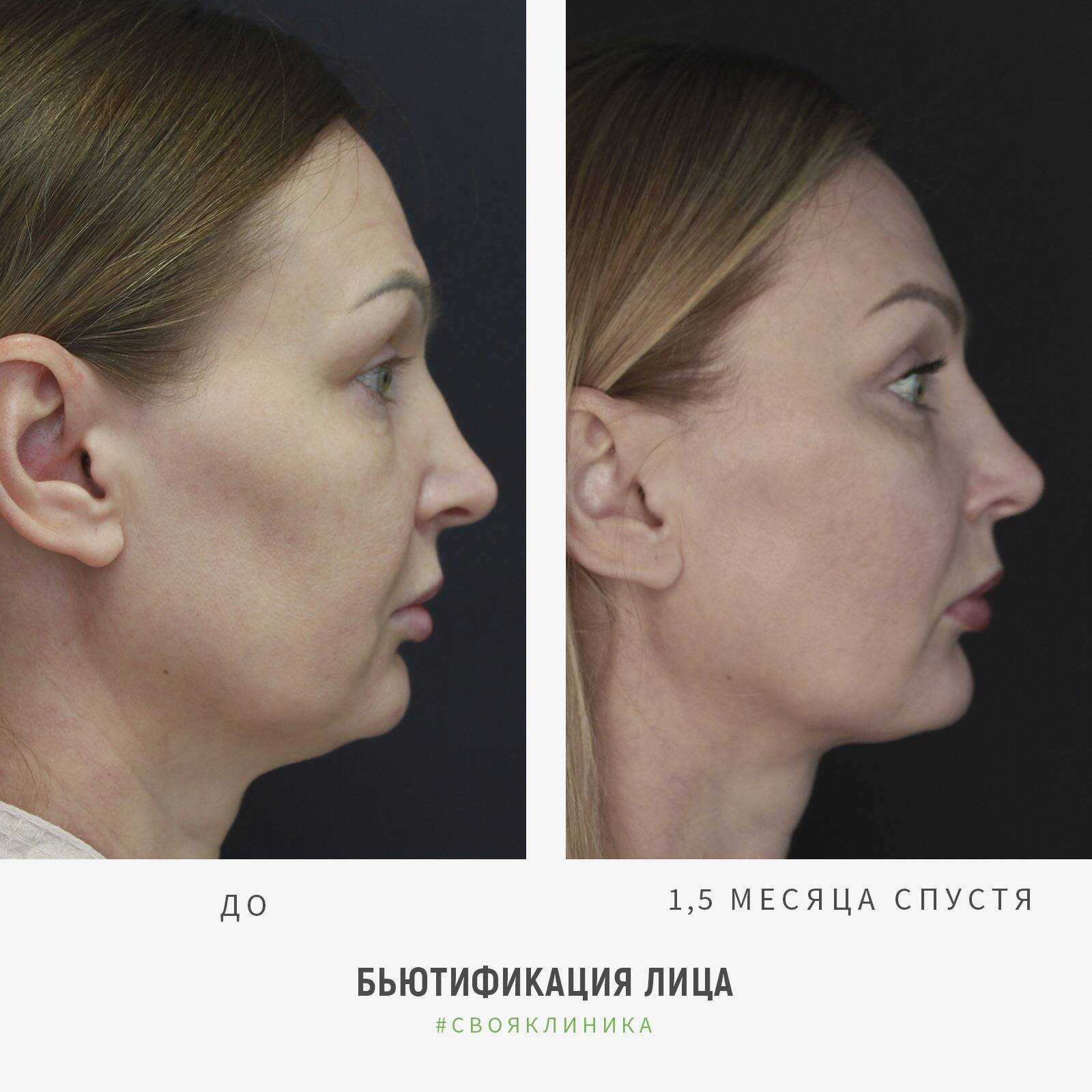 Эндоскопическая подтяжка лба – последствия, реабилитация