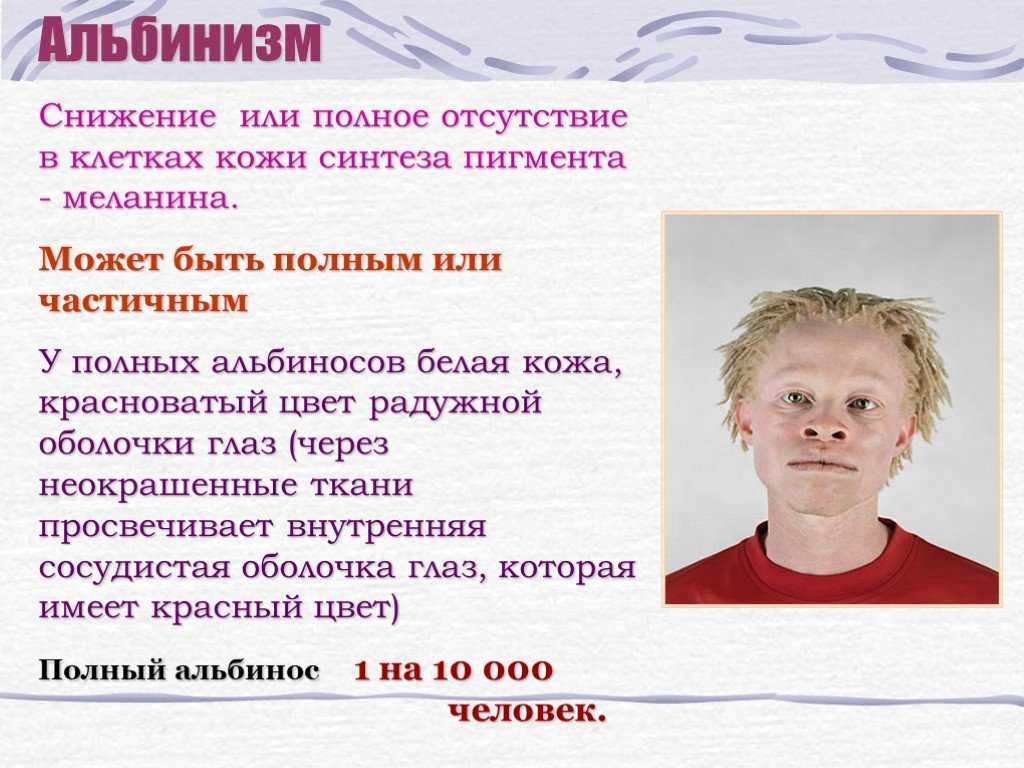 Кто такие дети-альбиносы: фото, интересные факты