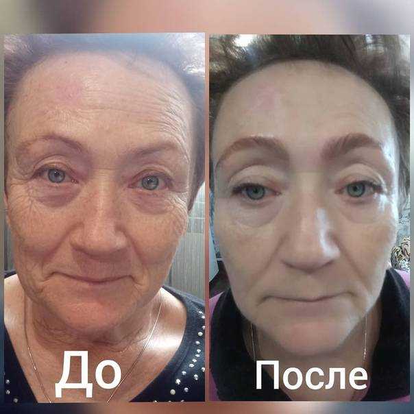 Мезоботокс: техника выполнения, эффект, противопоказания и другие аспекты + фото и отзывы