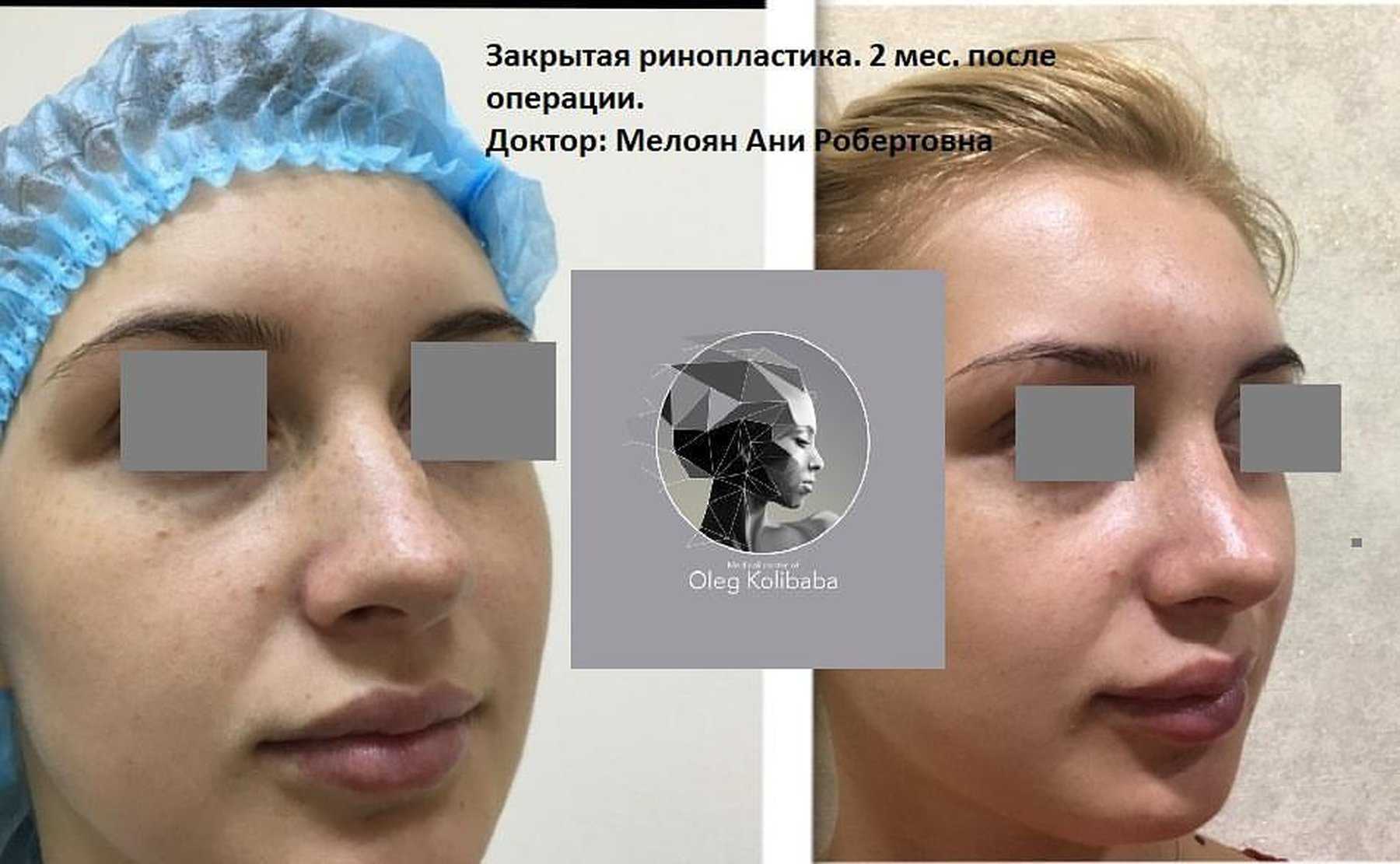 Отказано. почему хирург откажет вам в ринопластике