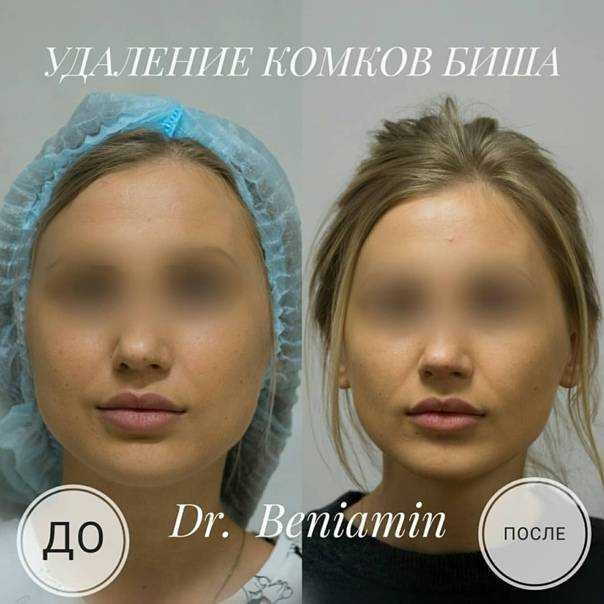 Кто из звезд удалял комки биша. анджелина джоли и еще 10 знаменитостей, которые удалили комки биша | школа красоты