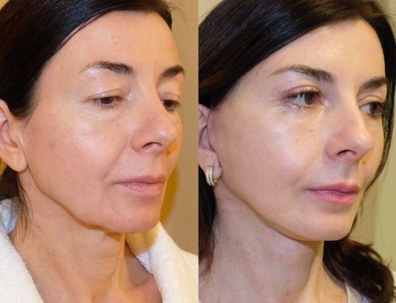 Потеря объема лица