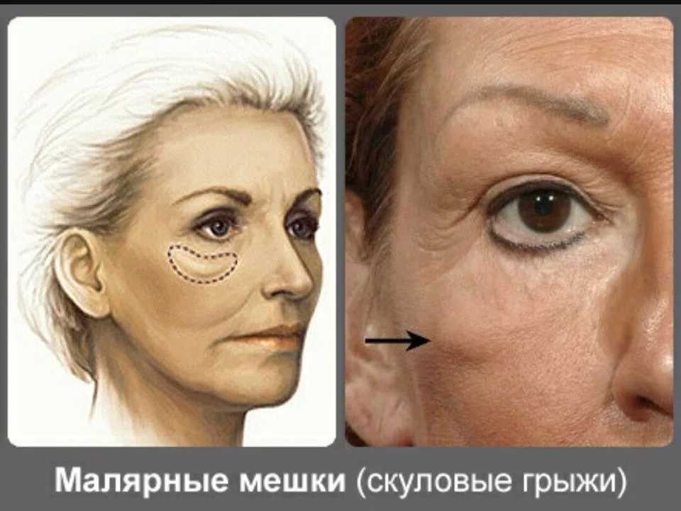 Как убрать малярные мешки под глазами и на скулах ✔️ блог клиники лица