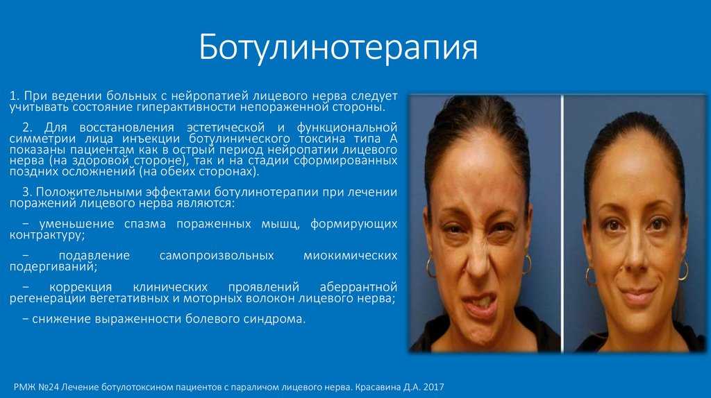 Последствия ботокса. предупрежден – значит вооружен