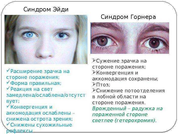 Почему зрачки расширяются? причины увеличения и сужения зрачков человека