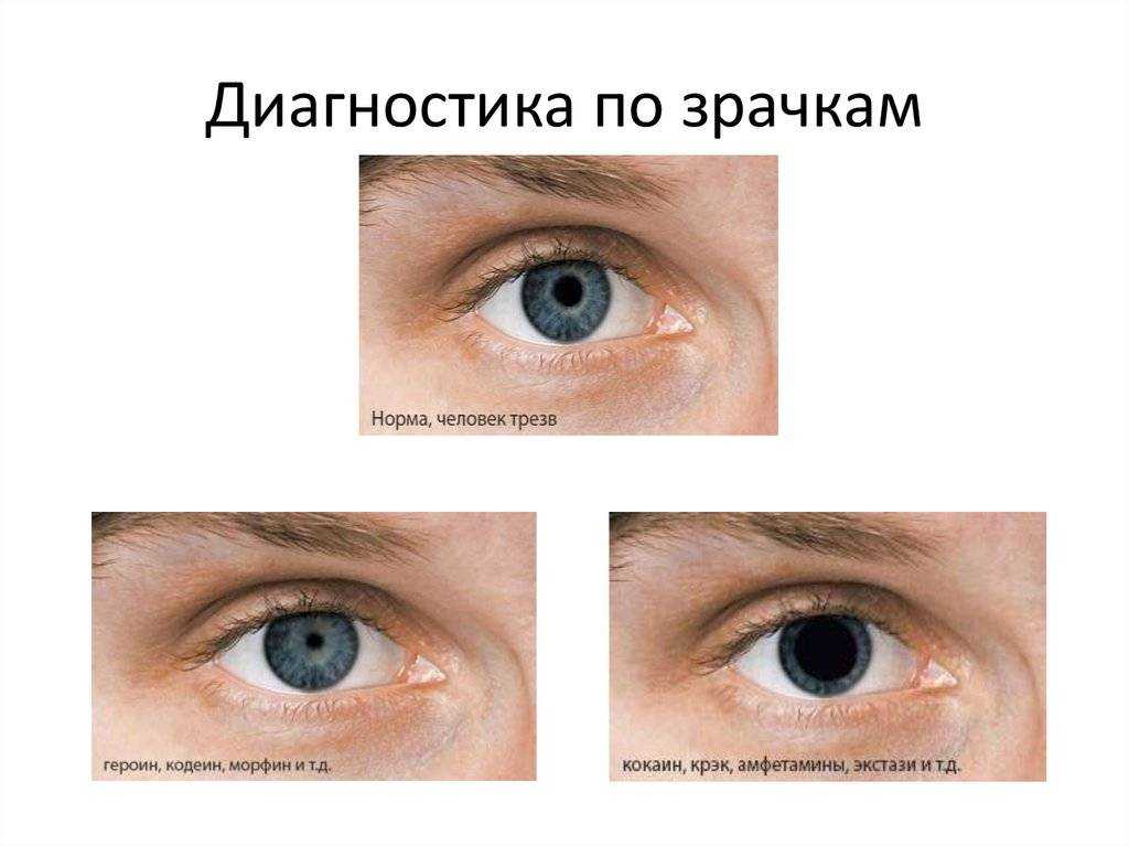 Расширенные зрачки - причины, симптом каких заболеваний