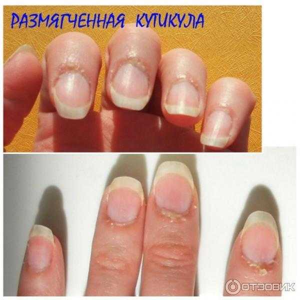 Почему растет кутикула на ногтях? тонкая кутикула. очень часто возникает вопрос что делать с тонкой налипшей кутикулой, которую не отдерешь с ногтя и которая кровоточит при любом не ловком движении? что делать если кутикула приросла к ногтю