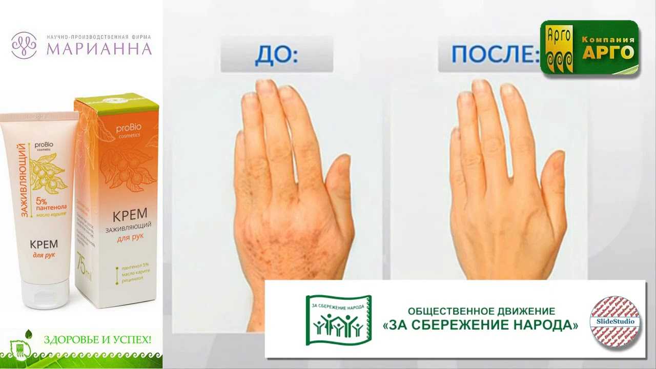 Липофилинг рук или как омолодить кожу на руках | пластический хирург осин максим александрович