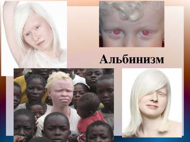 Люди альбиносы: фотографии и интересные факты