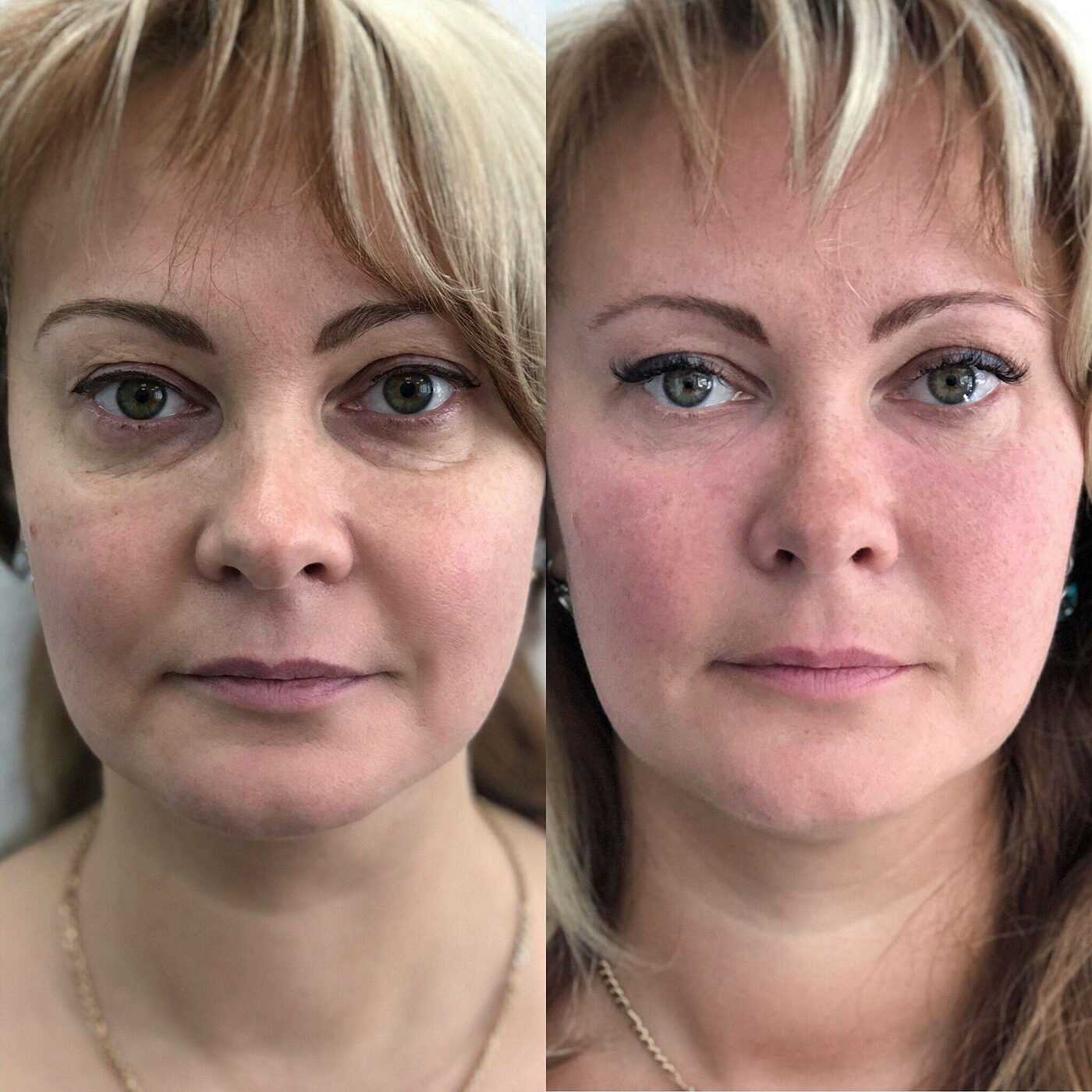 Как снять симптомы усталости с лица