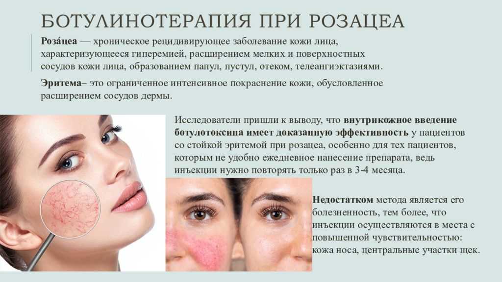 После ботокса опустились веки, что делать, фото, отзывы