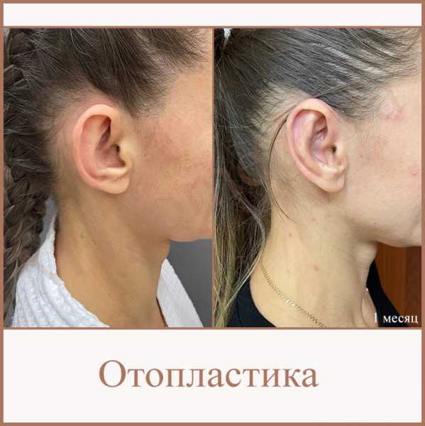 Все об отопластике (косметическая хирургия уха) - здоровье - 2023