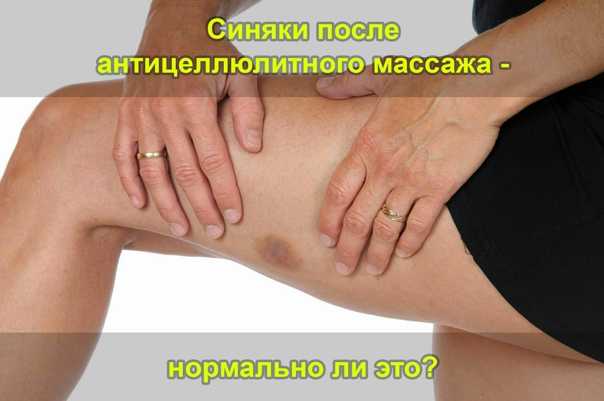 Независимо от техники массажа у некоторых людей могут оставаться синяки Рассказываем, почему это происходит, и когда гематомы свидетельствуют о более серьезной проблеме