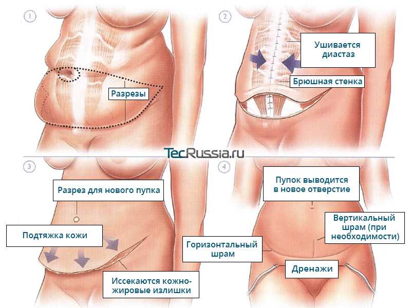 Что такое серома послеоперационного шва: лечение,