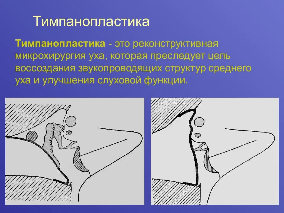 Тимпанопластика