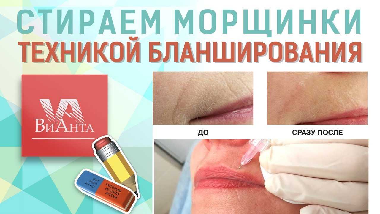 Что такое бланшинг, и для каких целей применяется в косметологии?