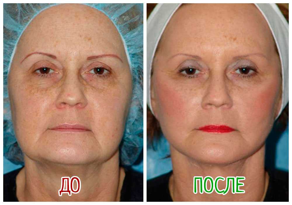 Подтяжка лица – все виды эффективного лифтинга лица с операцией и без