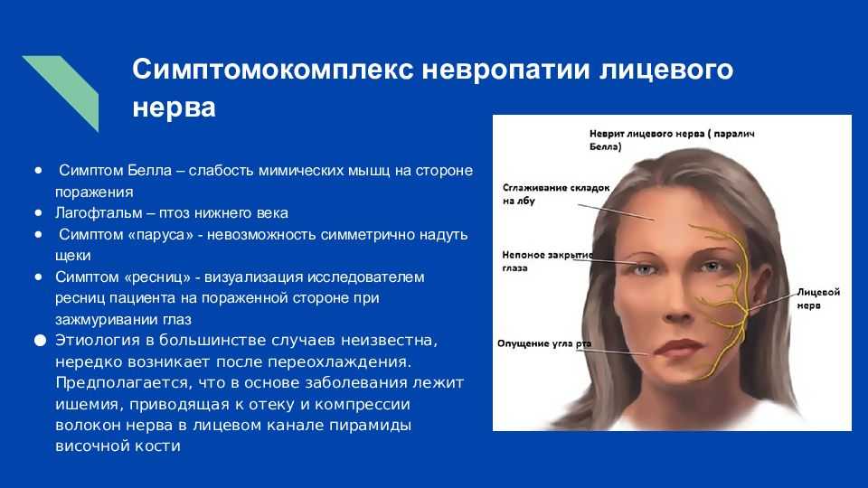 Невропатия лицевого нерва - лечение, симптомы, причины, диагностика | центр дикуля