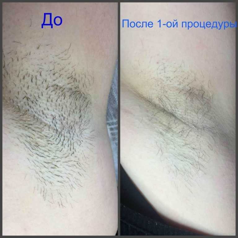 Как избавиться от волос на теле в домашних условиях и на лице
